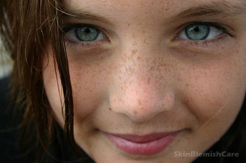 Facial Skin Spots 24